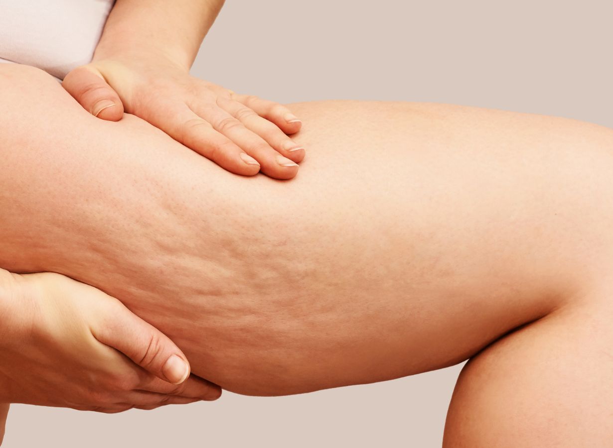 How Can Lasers Remove Cellulite?