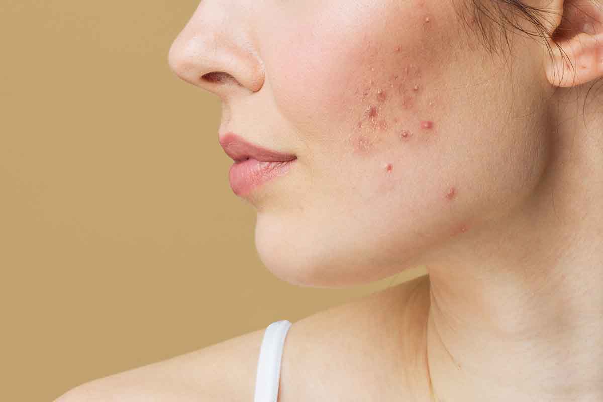 adult hormonal acne